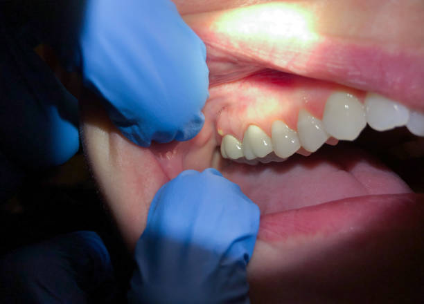 Best Emergency Treatment for Oral Infections in Topeka, IN